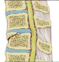 Spinal Cord Injury North American