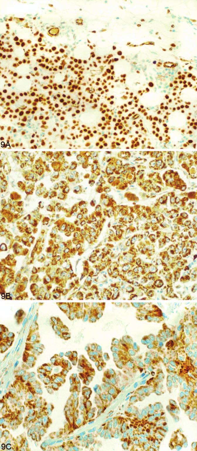 Figure 10. D2-40 immunohistochemical staining. A, Strong membranous staining in malignant mesothelioma (original magnification 200).