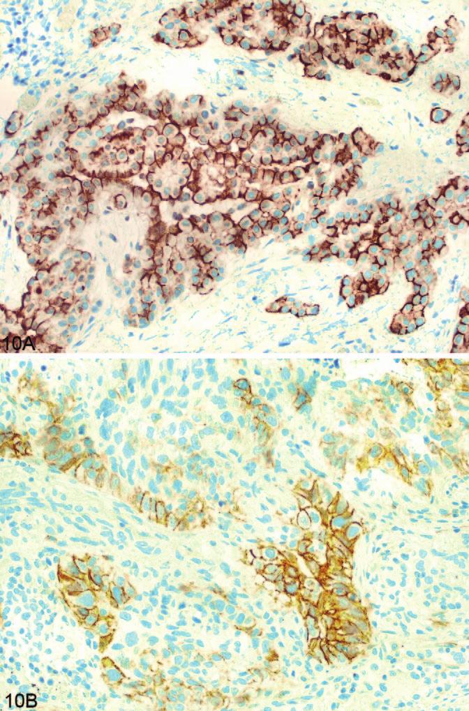 Note that endothelial cells show cytoplasmic staining only (original magnification 200). B, Strong granular cytoplasmic staining in large cell carcinoma (original magnification 400).