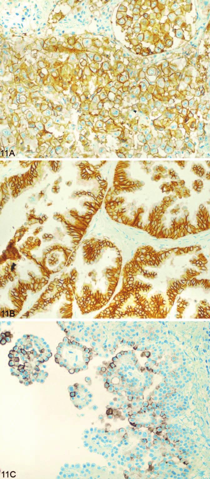 Figure 12. Thyroid transcription factor 1 immunohistochemical staining shows strong nuclear staining in lung adenocarcinoma (original magnification 400). Figure 13.