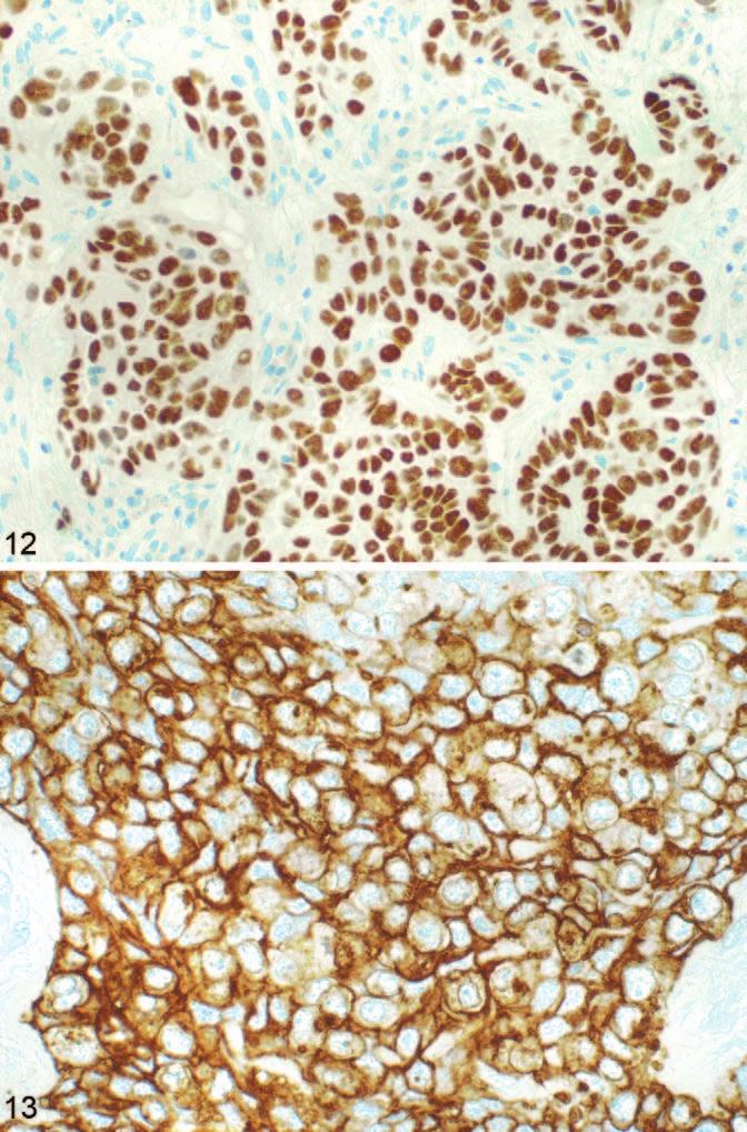 A, Large cell carcinoma with membranous staining (original magnification 400). B, Papillary adenocarcinoma of lung with strong staining (original magnification 400).