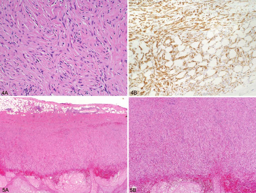Figure 4. Desmoplastic mesothelioma. A, Proliferation of bland-appearing spindle cells with haphazard growth pattern (hematoxylin-eosin, original magnification 200).