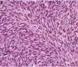 Sarcomatoid Mesothelioma Benign and intermediate mn potential spindle cell tumours of the Pleura: Schwannomas, Calcifying fibrous tumours Solitary fibrous