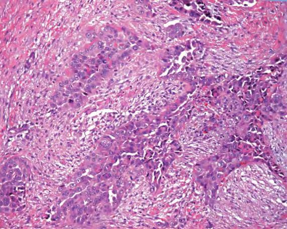 BIPHASIC MESOTHELIOMA Tumour with both epithelioid and sarcomatoid components; each component
