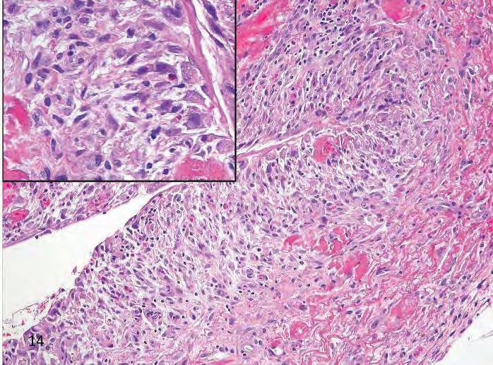 CYTOLOGICAL ATYPIA Sarcomatoid mesothlioma vs Chronic fibrous pleuritis Important features of a reactive pleuritis: 1.