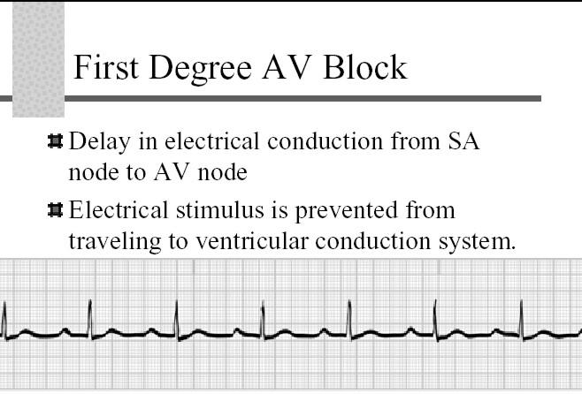 12 second, with positive wave in V 1 3 Left bundle branch block (LBBB) Electrical impulses don t reach left side of