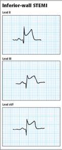 s inferior or bottom wall Inferior infarction Inferior infarction I II III av avl avf V1 V2 V3 V4 V5