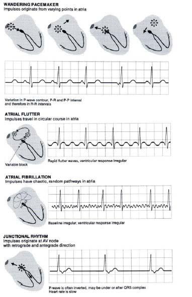 ventricular contractions (VCs) Wide abnormal premature S complex Due to