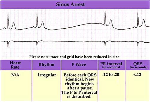 Sinus Arrest Sinus Arrest 97 98 Sinus Arrest Etiology Occurs when the sinus node fails to discharge.