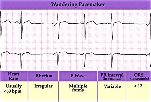 Wandering Atrial Pacemaker Wandering Atrial Pacemaker 105 Etiology Variant of sinus dysrhythmia, which is a natural phenomenon in the very young or old.