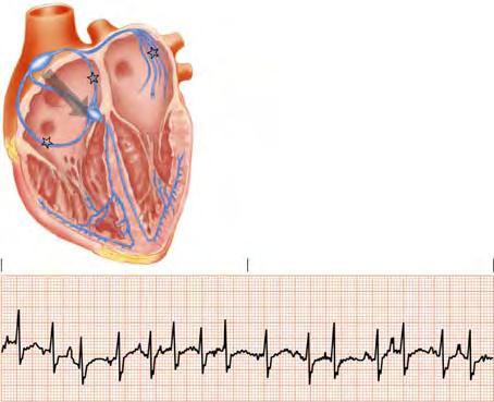 Multifocal Atrial Tachycardia Multifocal Atrial Tachycardia 109 Etiology Often seen in acutely ill patients. May result from pulmonary disease, metabolic disorders, ischemic heart disease, or recent.