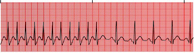 PSVTs Supraventricular Tachycardia Etiology: Rapid atrial depolarization overrides the node. May be precipitated by, overexertion, smoking, caffeine.