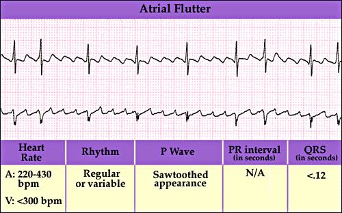 Atrial Flutter Atrial Flutter 137 138 Atrial Flutter Etiology: Results when the node cannot conduct all the impulses. Impulses may be conducted in fixed or ratios.