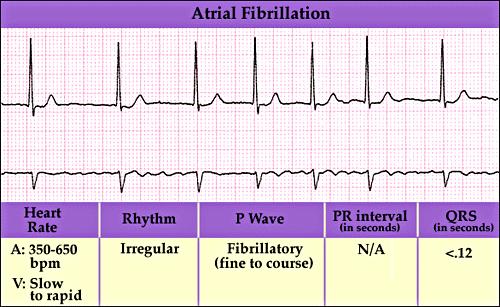 Atrial Fibrillation (A-Fib) Atrial Fibrillation (A-Fib) 145 146 Atrial Fibrillation (A-Fib) Etiology Results from multiple foci; AV conduction is random and highly variable.