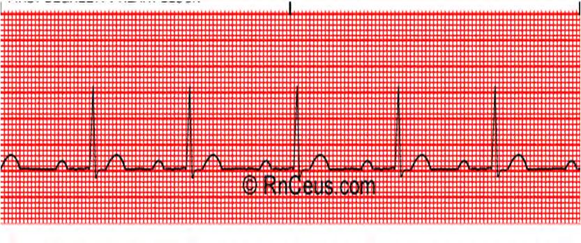 First Degree AV Block First Degree AV Block 157 Etiology Delay in the conjunction of an impulse through the AV node. May occur in hearts, but often indicative of ischemia at the AV junction.