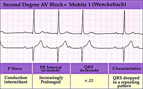Type I Second Degree AV Block Keys to Interpretation: PRI until a QRS drops out Each is caused by a P-Wave Rules of Interpretation: Type I Second Degree AV Block Rate: is normal, Ventricular is