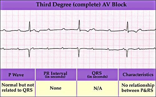 Third Degree AV Block Third Degree AV Block 177 178 Third Degree AV Block Etiology Absence of conduction between the atria and the ventricles.