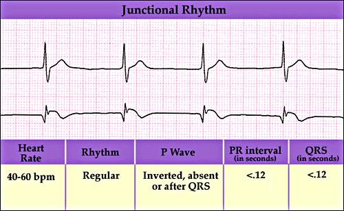 Junctional Escape Complexes and Rhythms Junctional Rhythm 189 190 Junctional Escape Complexes and Rhythms Etiology Results when the AV node becomes the pacemaker.