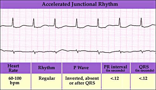 Accelerated Junctional Rhythm Description: results from increased automaticity in the AV junction, causing the AV junction to discharge faster than its rate.