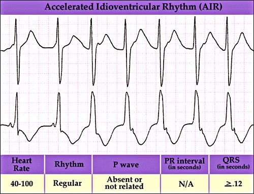 Ventricular Escape Complexes and Rhythms Treatment: For perfusing rhythms, administer and/or TCP (Pacing). For nonperfusing rhythms, follow pulseless electrical activity ( ) protocols.