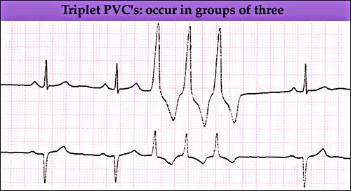 PVC Triplets Bigeminy 221 222 PVCs Etiology Single ectopic impulse resulting from an