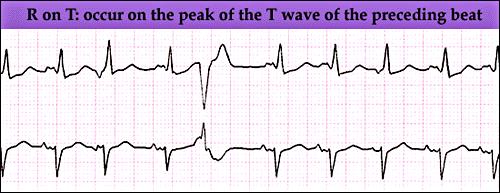 PVCs Clinical Significance: Malignant PVCs: More than /minute, R on T phenomenon, couplets or runs of ventricular tachycardia, PVCs, or PVCs associated with chest pain.