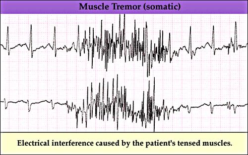 Muscle Tremor Artifact 60 Cycle Interference 21