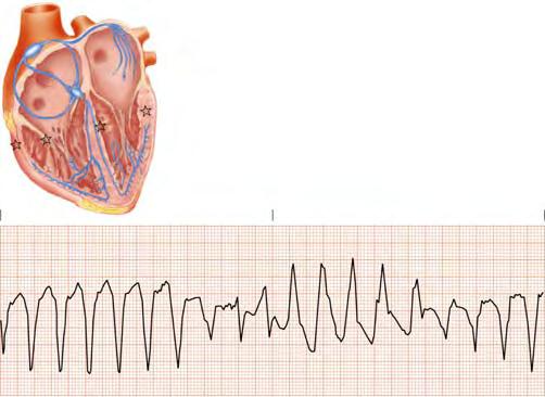 Treatment of V-Tach Non-Perfusing Patients (No Pulse): Treat as Ventricular (V-Fib) Torsade de Pointes Typically occurs in nonsustained bursts. Prolonged - interval during breaks.