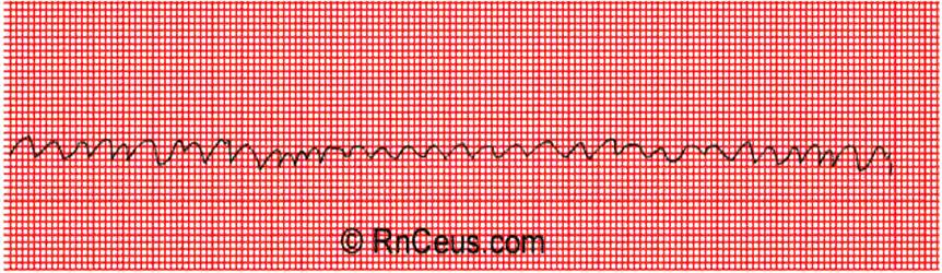 numerous ectopic foci throughout the P-Waves: