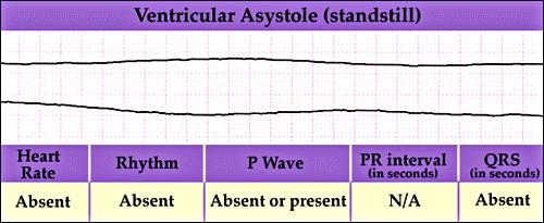 Asystole Asystole 265 266 Asystole Etiology Primary event in cardiac arrest, resulting from massive myocardial infarction, ischemia, and necrosis. outcome of ventricular fibrillation.
