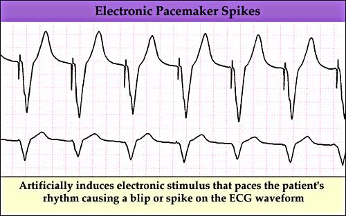 Pacemaker Rhythm 273
