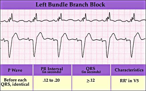 Bundle Branch Block Can involve either the left or right bundle branch If both branches are involved, then a degree block exists Causes Ischemia or