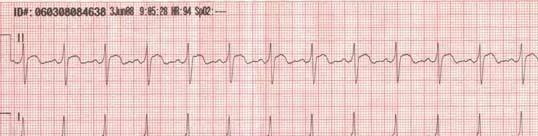Wolf-Parkinson-White Syndrome (WPW) ECG Changes Due to Electrolyte Abnormalities and Hypothermia