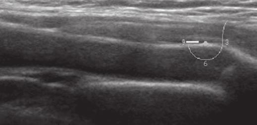 and, Focused ultrasound images of anterior chest wall show abnormal contour of cartilage at left chest wall