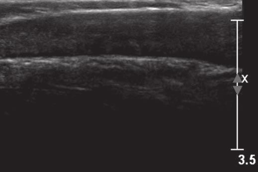 palpable anterior chest wall mass bilaterally.