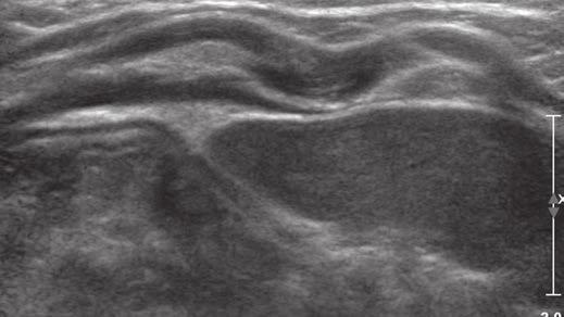 D, Focused ultrasound images obtained in transverse ( and ) and longitudinal (