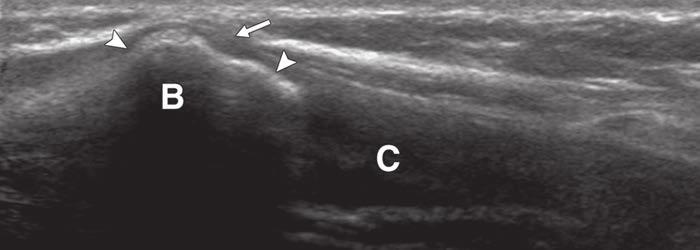 E, Drawing shows hypertrophy and elongation with mild angulation (box) of right costal cartilage.