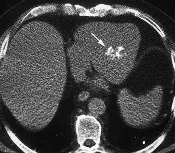 CE Peer Directed Review Reading Computed Tomography of Cardiac Malignancies be misdiagnosed as myxomas, particularly in the left atrium, but can be differentiated by a broad base and tumor extension