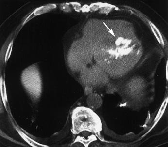 3,19 Pericardial and atrial-septal infiltration also might be noted on CT images of osteosarcomas.
