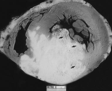 3 In CT images, primary cardiac lymphoma lesions are varied and generally nonspecific, but they often include a hypodense or isodense appearance compared with the myocardial tissues, with