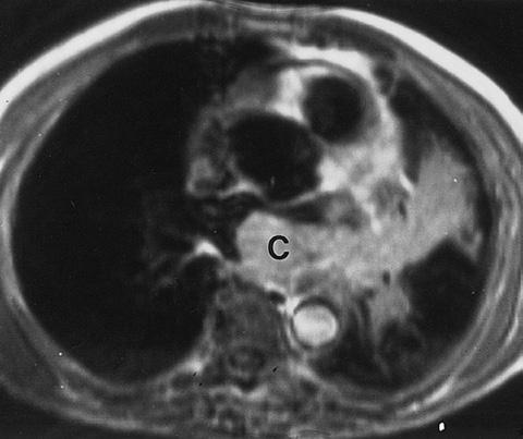 CE Peer Directed Review Reading Computed Tomography of Cardiac Malignancies A B Figure 8. A. Bronchogenic carcinoma in a 61-year-old man.