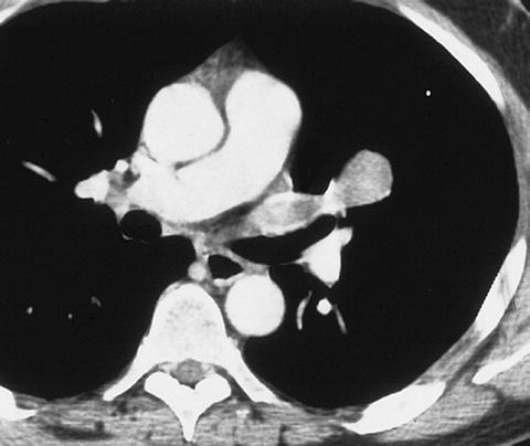 Axial CECT scan shows filling of the left superior pulmonary vein (arrow) by presumed tumor and thrombus. Reprinted with permission from Chiles C, Woodward PK, Gutierrez FR.