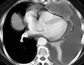 CECT image shows periportal fluid in the porta hepatis (curved arrow) and a hypoattenuating collar surrounding the intrahepatic portion of a distended inferior vena cava (IVC).