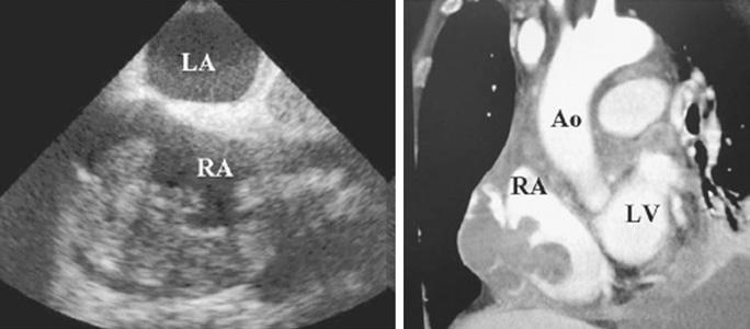 Furlow CE Directed Peer Reading Review A B Figure 3. Angiosarcoma. A. Transesophageal echocardiograph demonstrating a large, lobulated mass in the right atrium (arrows). B. Contrast nongated cardiac CT demonstrating a hypodense, multilobular mass in the right atrium (arrows).