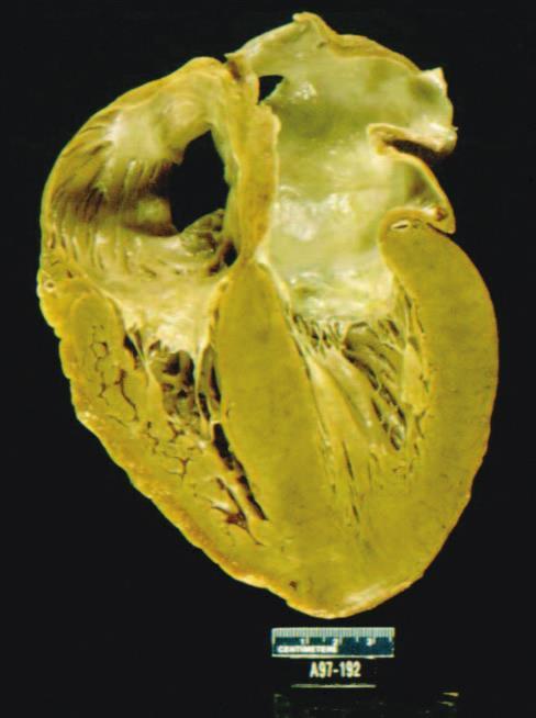 Clinical presentation of cardiac amyloid Heart failure Small vessel disease Syncope/SCD Conduction