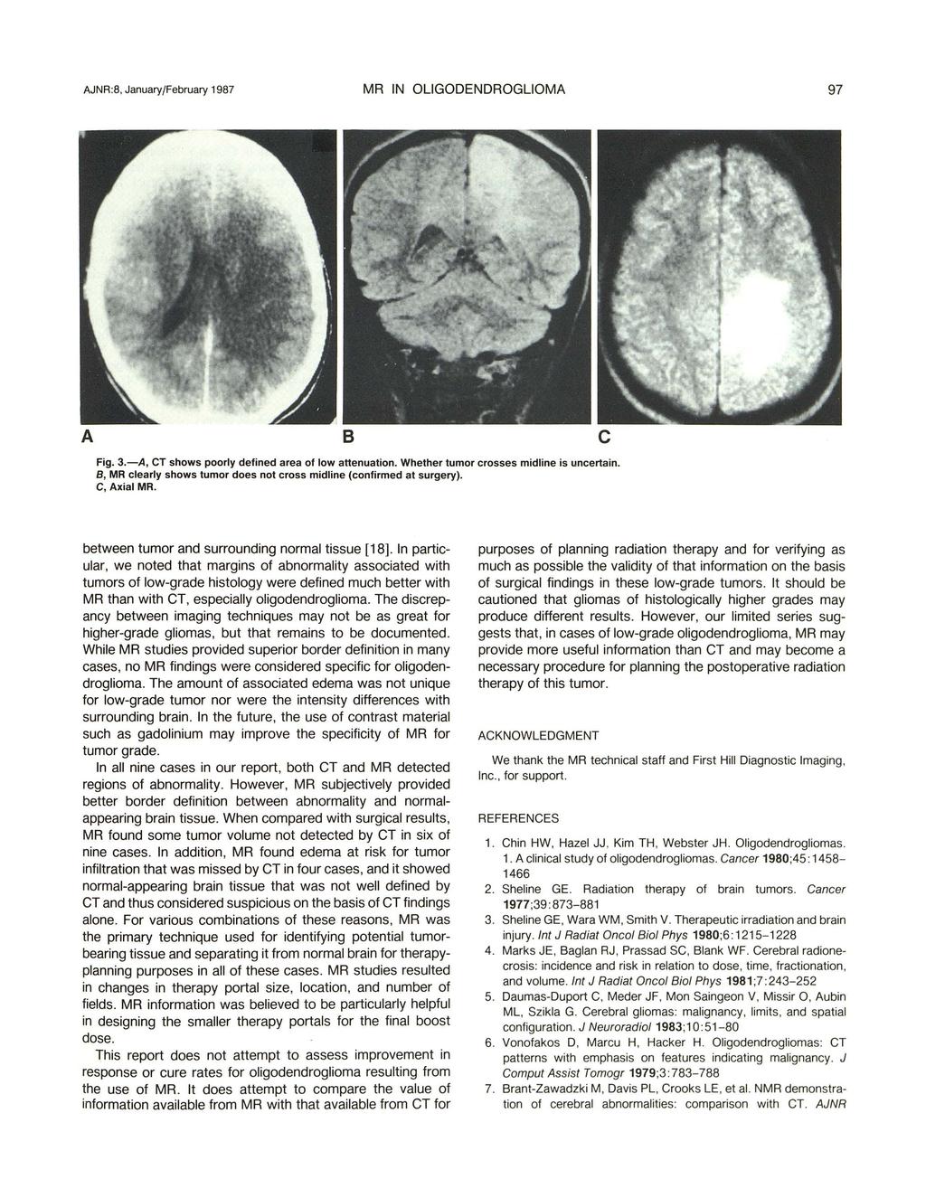 AJNR:8, January/February 1987 MR IN OLIGODENDROGLIOMA 97 A B c Fig. 3.-A, CT shows poorly defined area of low attenuation. Whether tumor crosses midline is uncertain.