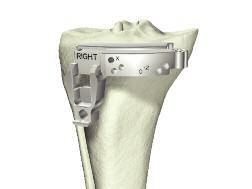 > The capsule is entered through a modified mid-vastus approach, which makes a 6-12cm skin incision medial to the patella from just above the tibial tubercle to just above the patella.