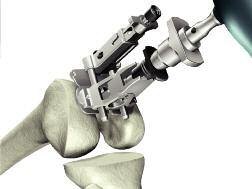 Set the instrument to the desired angle by pulling back on the black knob of the MIS Femoral Alignment Guide and placing it in the appropriate notch.