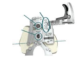 Posterior Referencing Surgical Protocol Femoral A/P Sizing > Pre-assemble the MIS Femoral Sizer Body (Left or Right) onto the MIS Femoral Sizer Adjustment Housing.