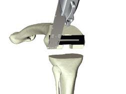 Posterior Referencing Surgical Protocol > The order of the cuts will be as follows: 1. Anterior Chamfer 2.